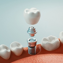 A 3D illustration of a dental implant and its parts