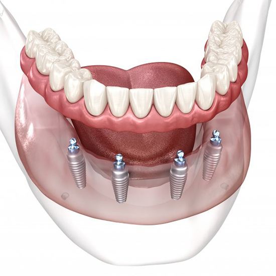 a 3D illustration of All-On-4 dental implants