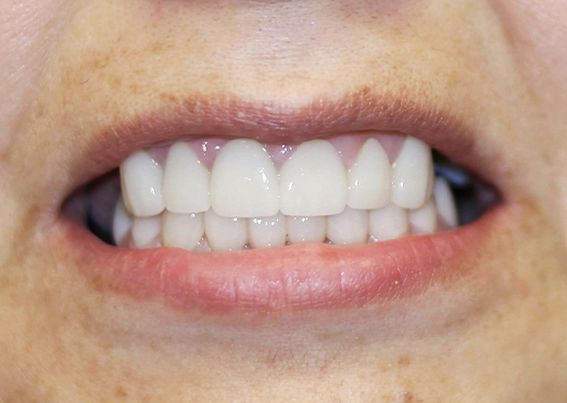 Case 27 after