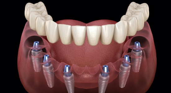 complete smile implant