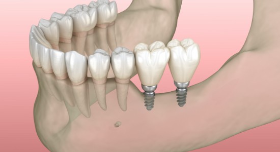 mini implant