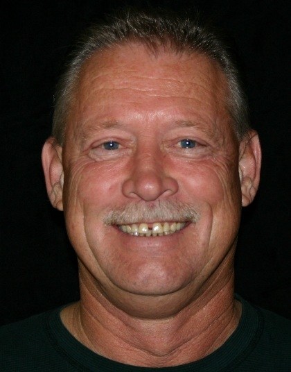 Smiling older man with gap between two front teeth