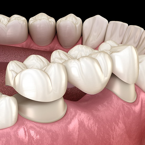 dental bridge