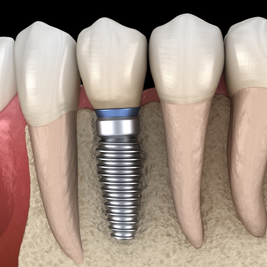 dental implants illustration