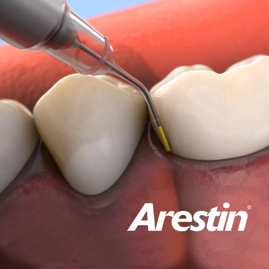 illustration of arestin therapy