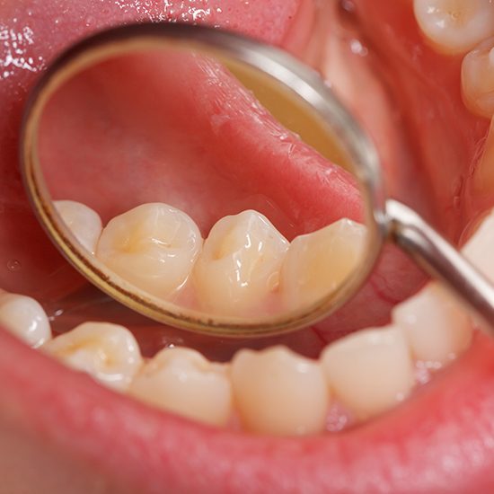 mirror showing dental sealants