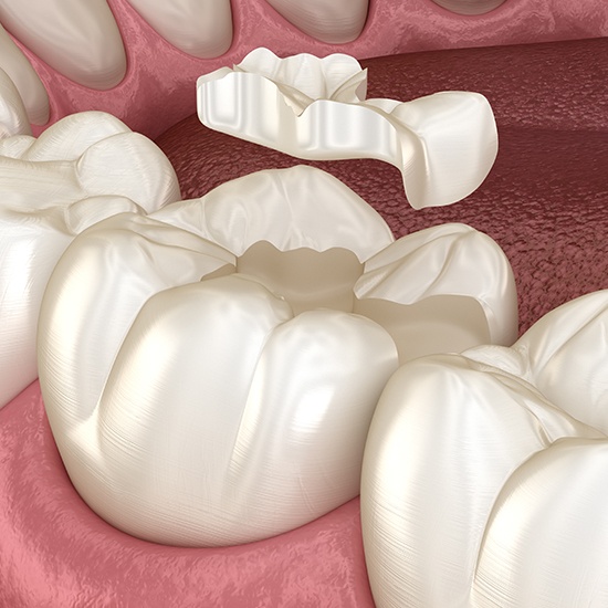 tooth colored filling illustration