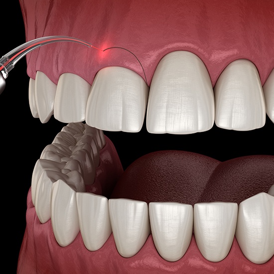 illustraion of crown lengthening