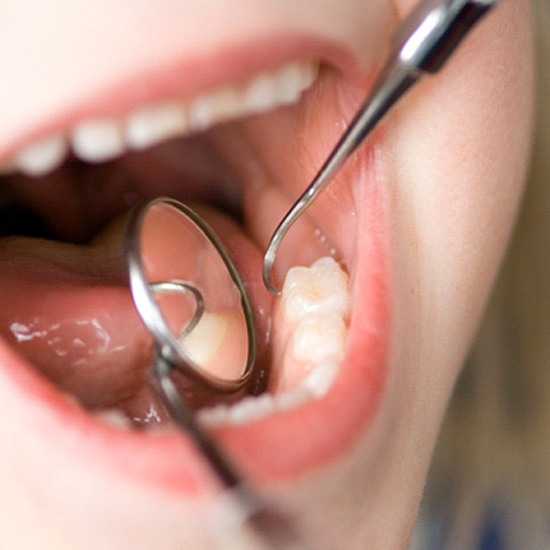 a patient receiving tooth-colored fillings in Grand Island