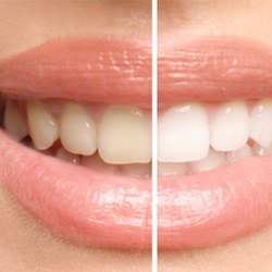 : Before and after of teeth whitening