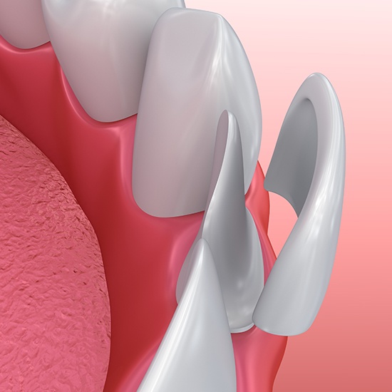 illustration of veneers