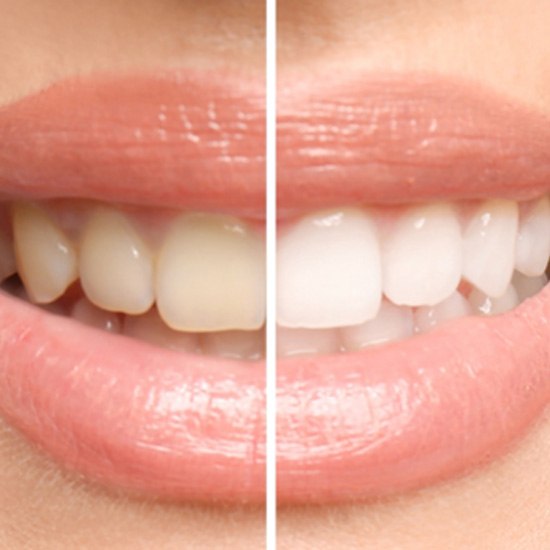 Closeup of patient's smile before and after teeth whitening