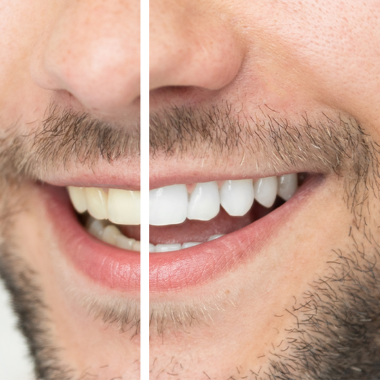 man's smile before and after whitening