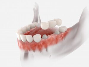 Animated model of dental bridge.